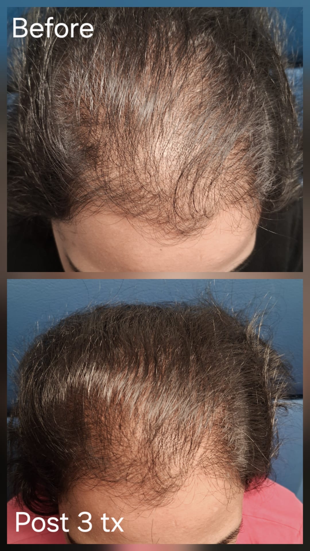 Hair restoration result